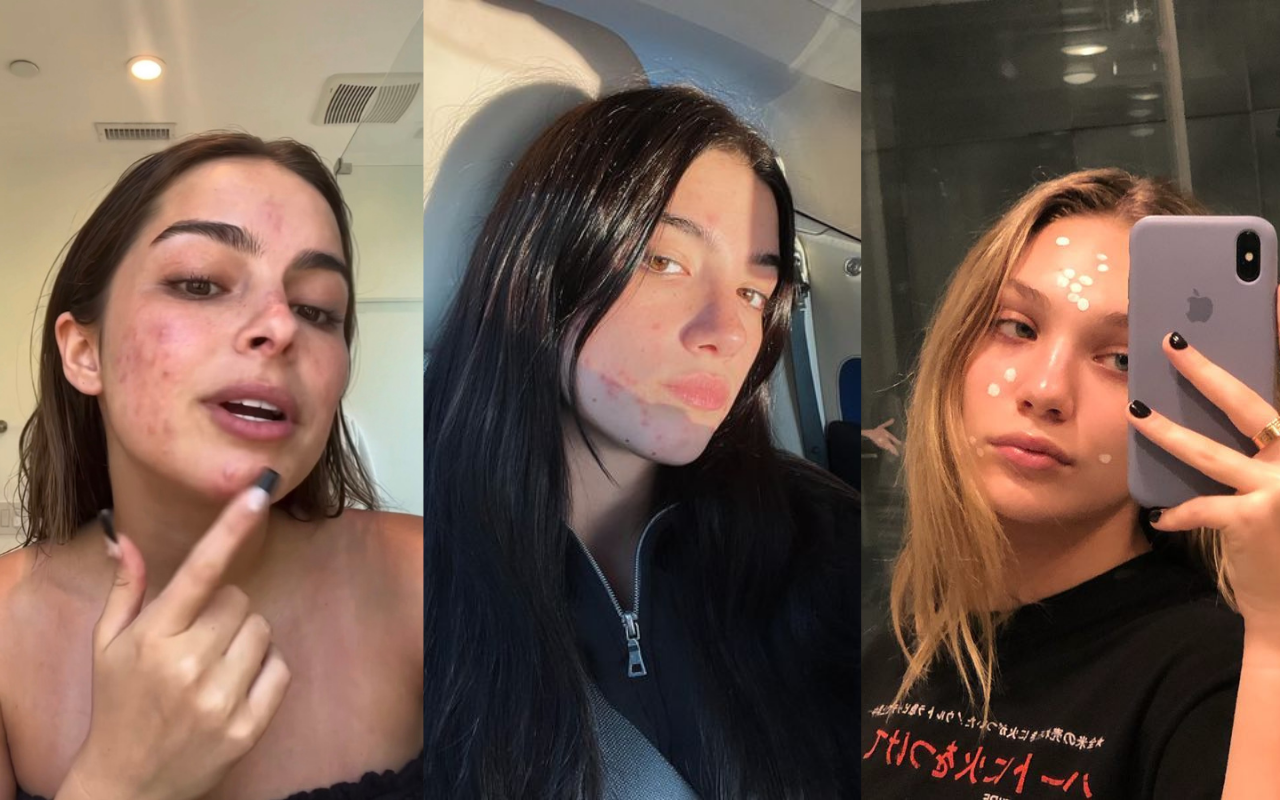 How Acne Became An Accessory To The Anti-“That Girl” Movement – Centennial  World: Internet Culture, Creators & News